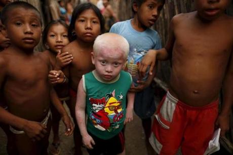 With their sensitive skin and eyes, young Guna albinos must be shuttled to and from school, avoiding the baking heat, while they watch their friends play in the streets.
