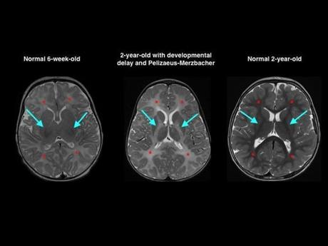 Doctors say MRIs of children?s brains are easily misread.
