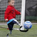 Braylon O’Neill, 4, tried dribbling a soccer ball with a new pair of prosthetic legs in Boston Sunday.