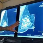 The American Cancer Society recognized on Tuesday that its previous guidelines on breast cancer screening were too aggressive.