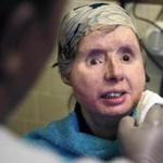 FILE - In this Feb. 20, 2015 file photo, Charla Nash smiles as her care worker washes her face at her apartment in Boston. The Connecticut woman who underwent a face transplant five years ago after being attacked by a chimpanzee is back in a Boston hospital after doctors discovered her body is rejecting the transplant. Nash says doctors have decided to end an experimental drug treatment and put her back on her original medication in the hopes of reversing the rejection. (AP Photo/Charles Krupa, File)