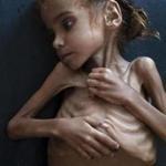 Amal Hussain, 7, who suffered from severe acute malnutrition. 